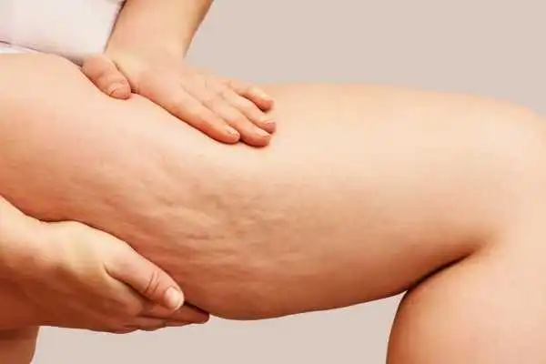 Image of woman showing leg with cellulite Blandford Forum