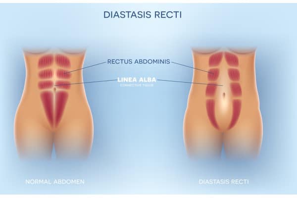 What Non-Surgical Options Are Available for Diastasis Recti Blandford Forum?