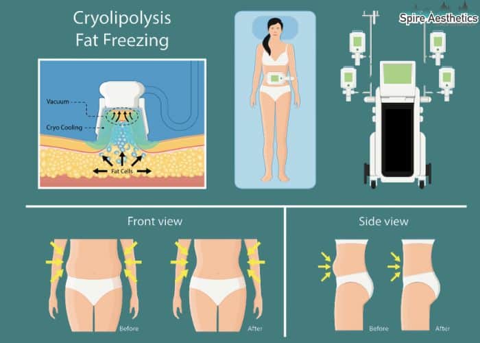 Image of diet and fat freezing combined for best results for Spire Aesthetics Blandford Forum
