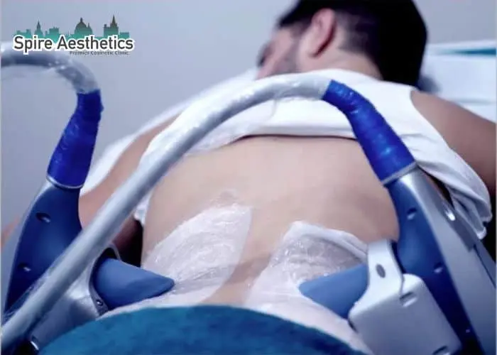 Man having fat freezing treatment done on love handles before a competitions Blandford Forum to create a sculpted look.