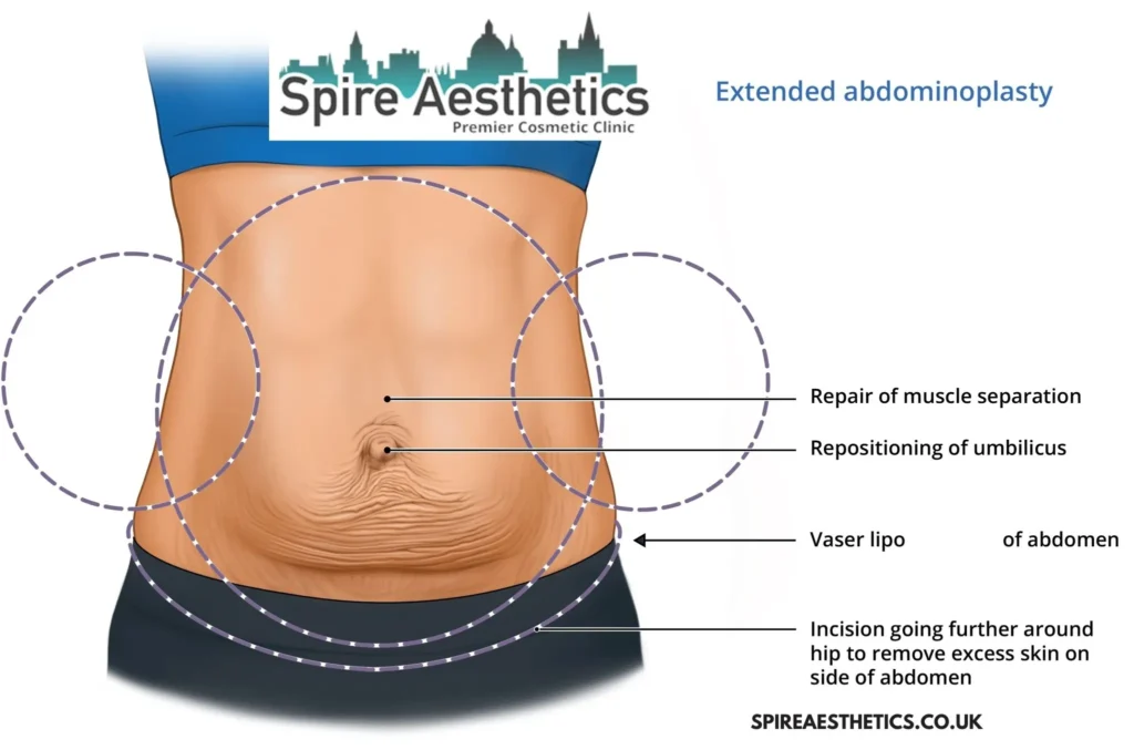 Understanding Loose Skin After Gastric Band Blandford Forum Surgery and HIFU Treatment