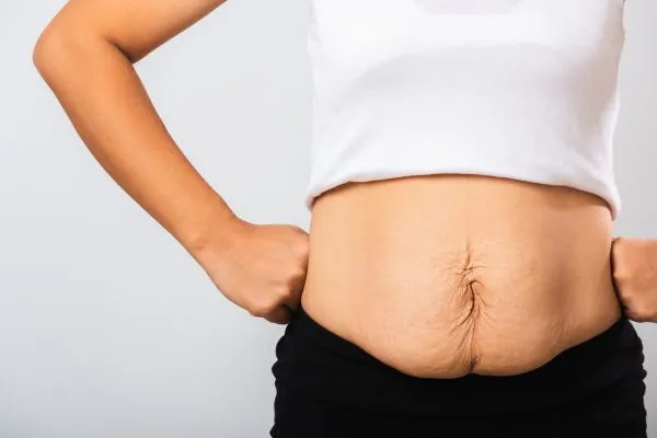 Image of a woman's stomach after weight loss with sagging skin following a gastric band Blandford Forum