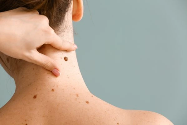 skin blemish removal Blandford Forum treatment