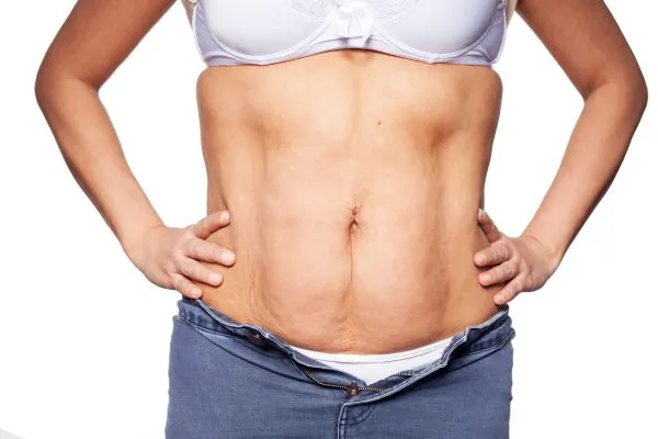 sagging skin on woman's stomach after weight loss injections Blandford Forum