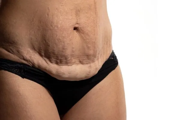 Image of womans stomach after weight loss injections Blandford Forum showing saggy skin