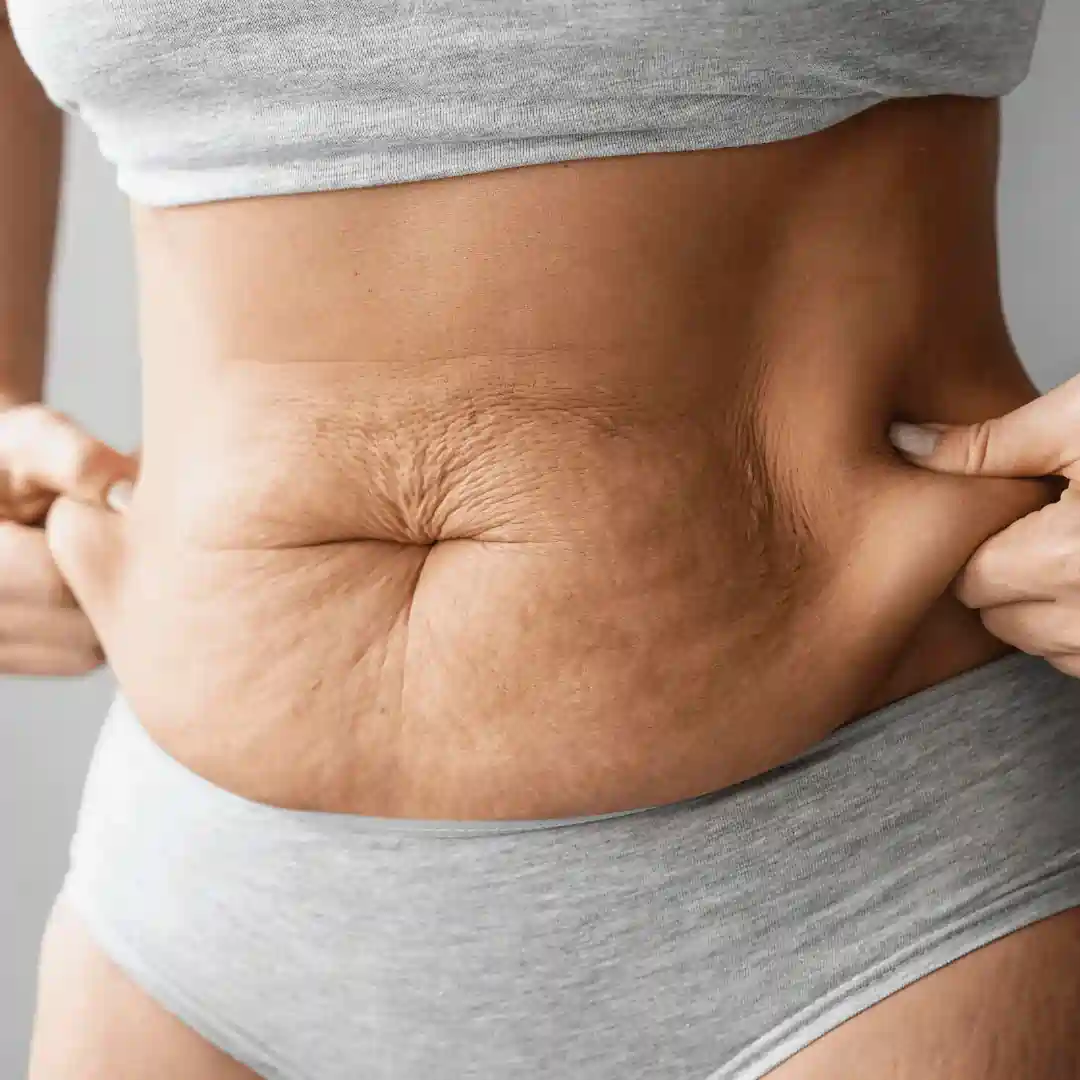 Is It Normal to Have Loose Skin After Pregnancy Blandford Forum?